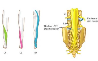 Sciatica